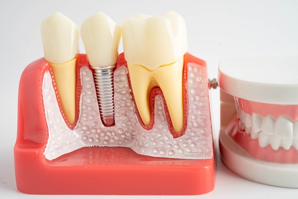 When Dental Implants Are The Ideal Teeth Replacement Option