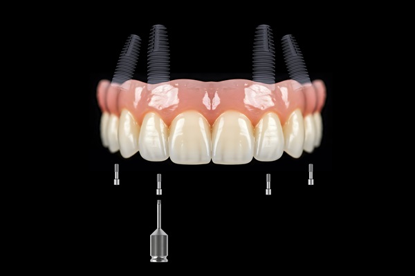 Implant Supported Dentures: Reasons To Consider All On